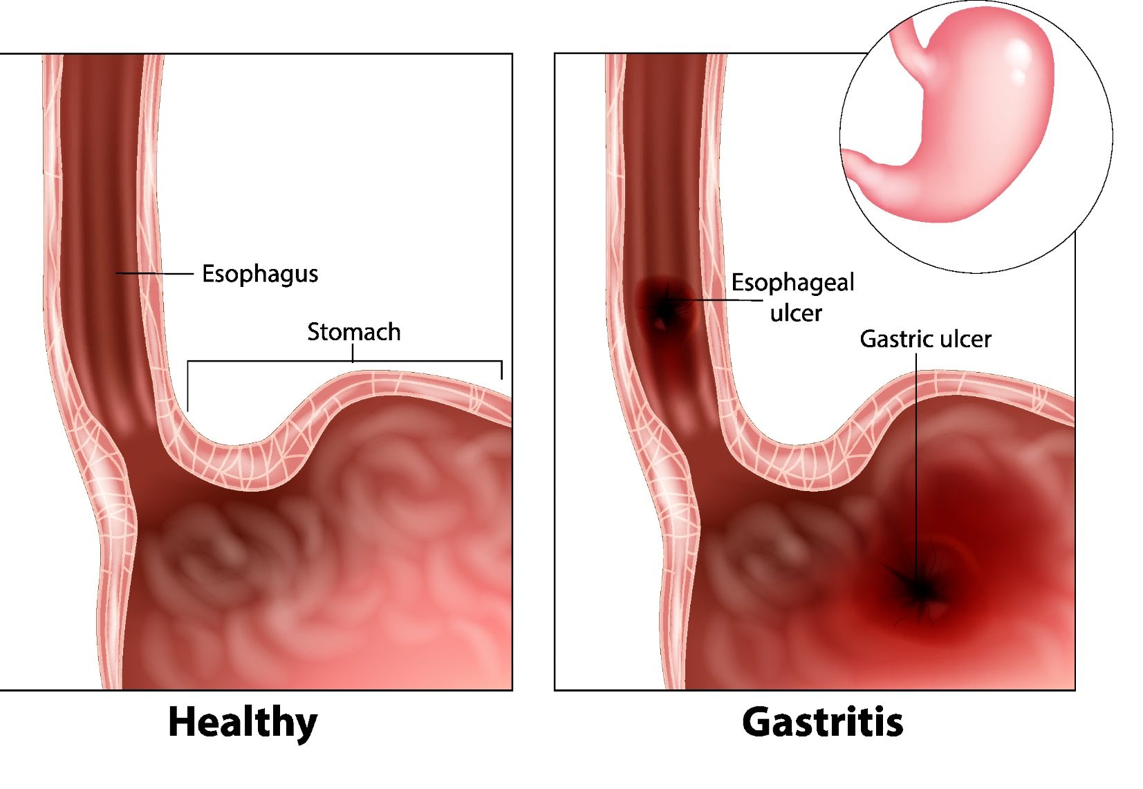 conditions-such-as-gastritis-and-a-rupture-in-the-gastrointestinal