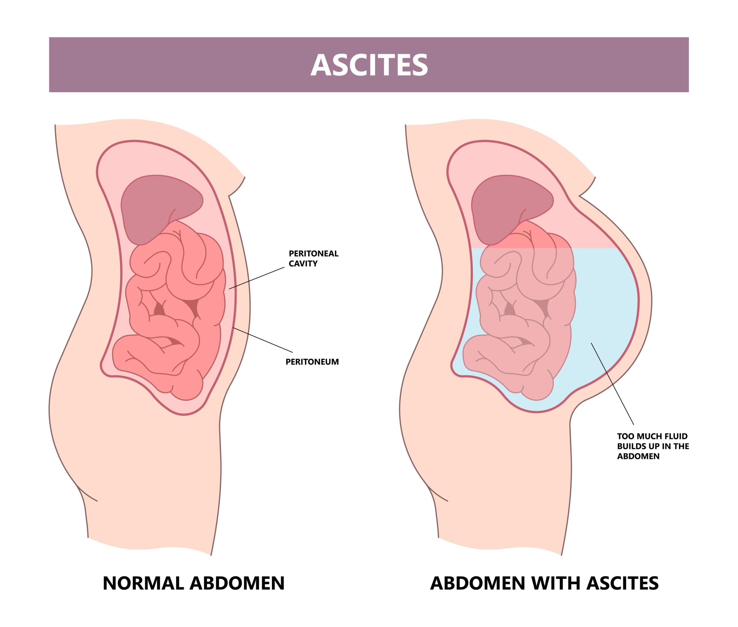 Ascites From Drinking Alcohol Rehab Guide