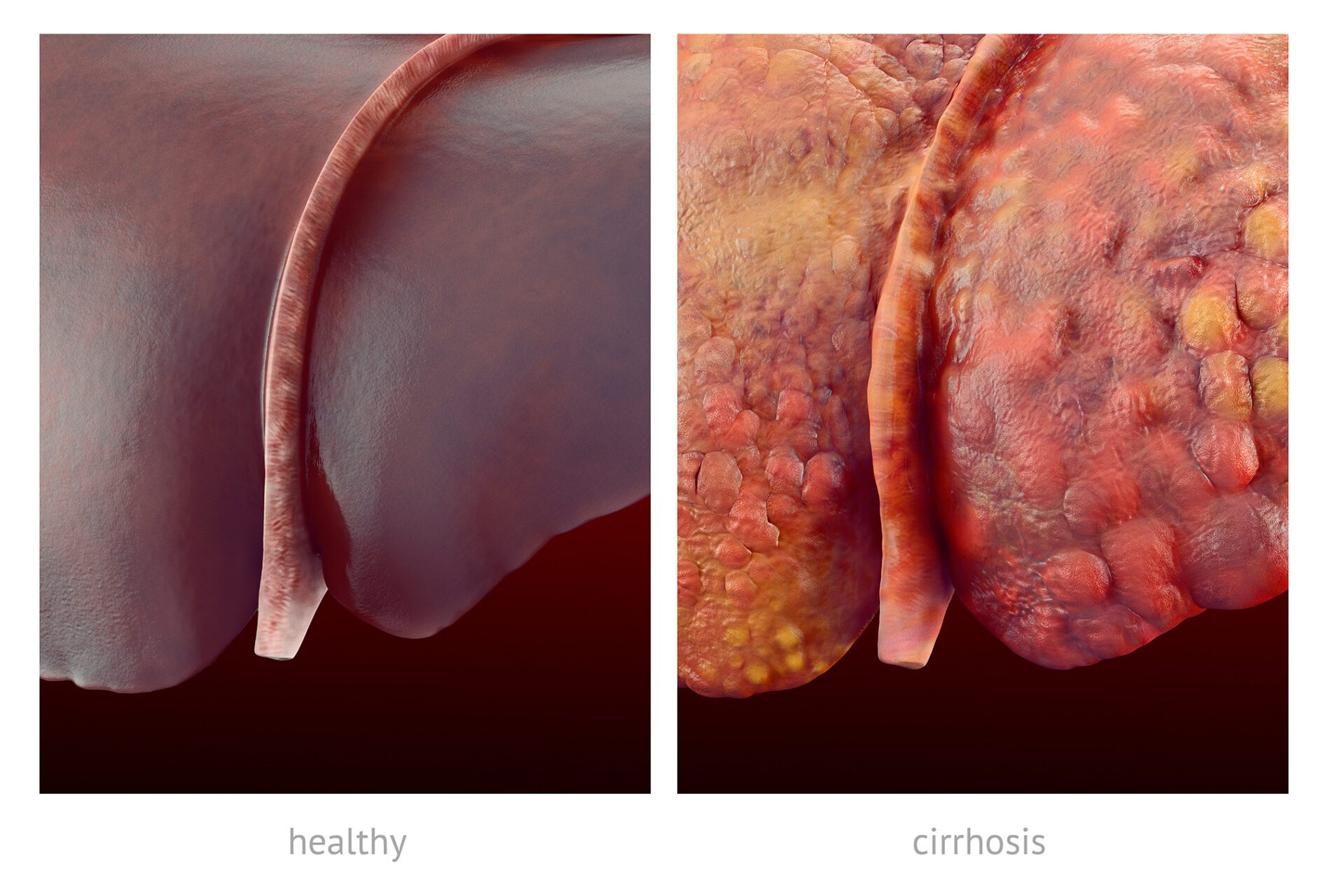 Contrasting Liver Disease Symptoms: Healthy vs Cirrhosis Image showing liver disease symptoms: healthy liver vs cirrhosis